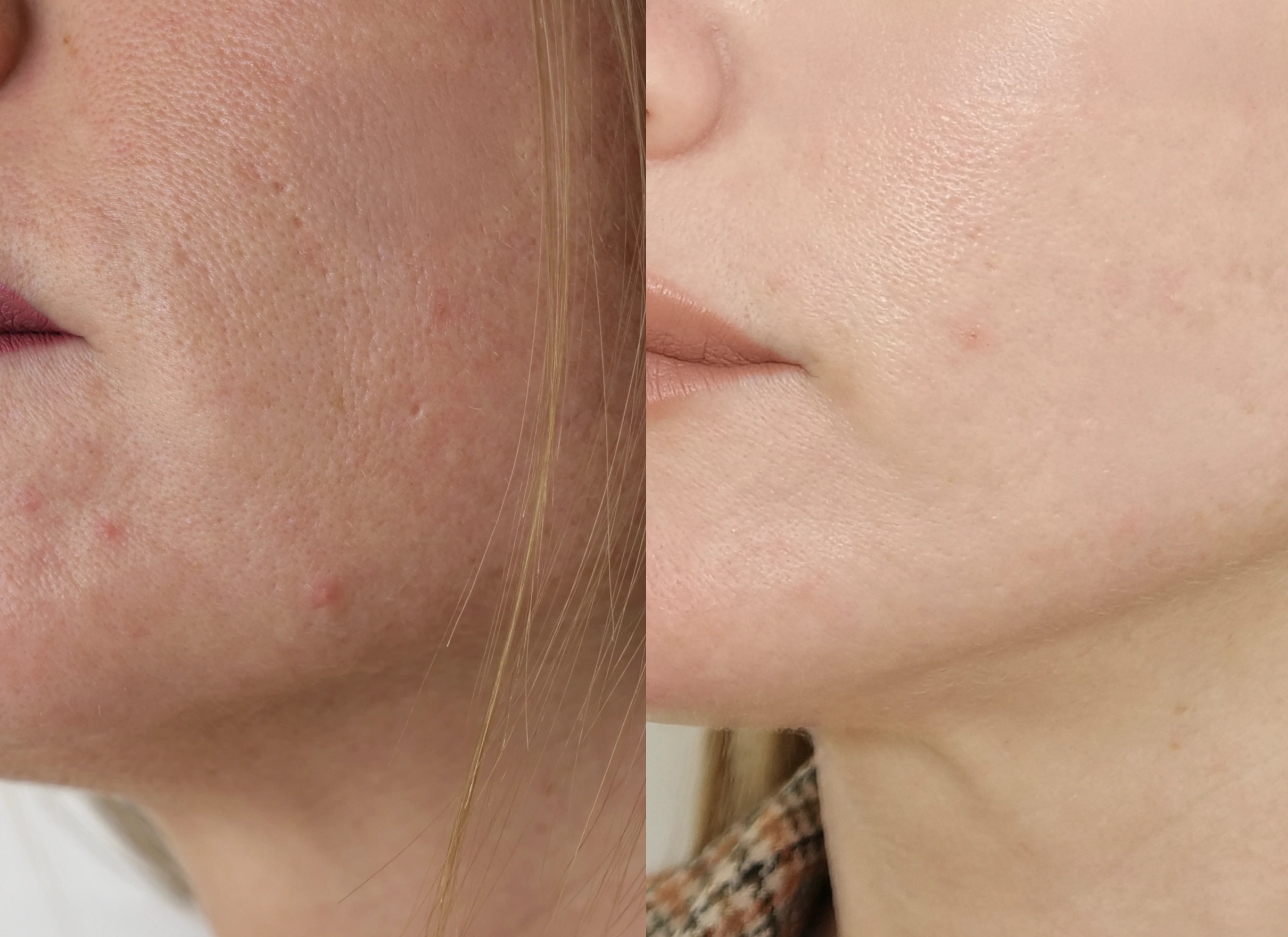 Resultados de Morpheus 8 Rejuvenecimiento facial y corporal